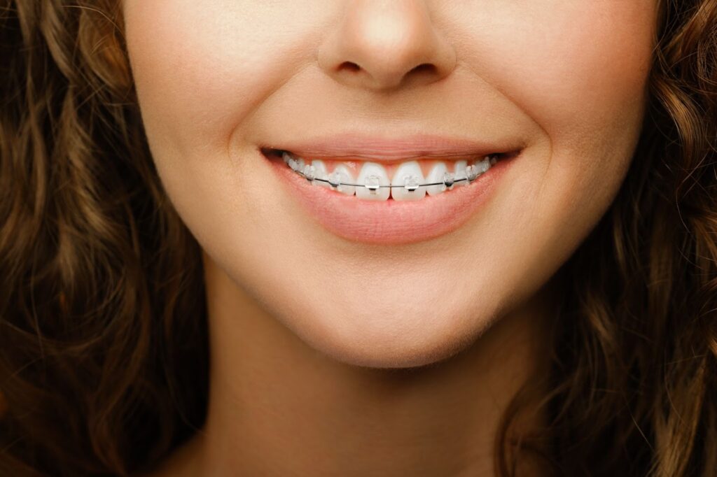 The Advantages of Clear Braces